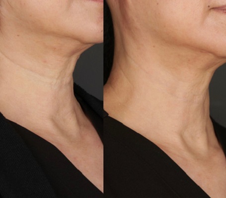 Neck Rejuvenation