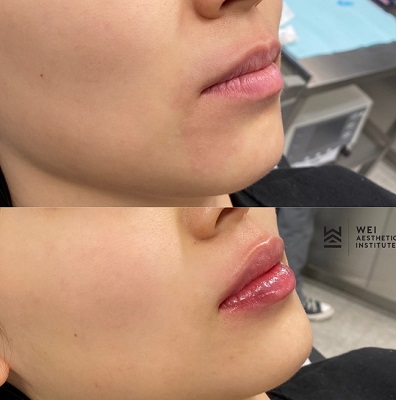 Lip Filler