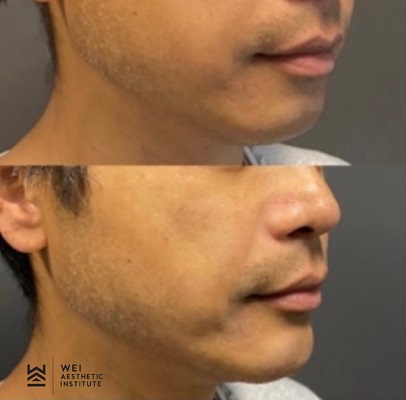 Chin Filler